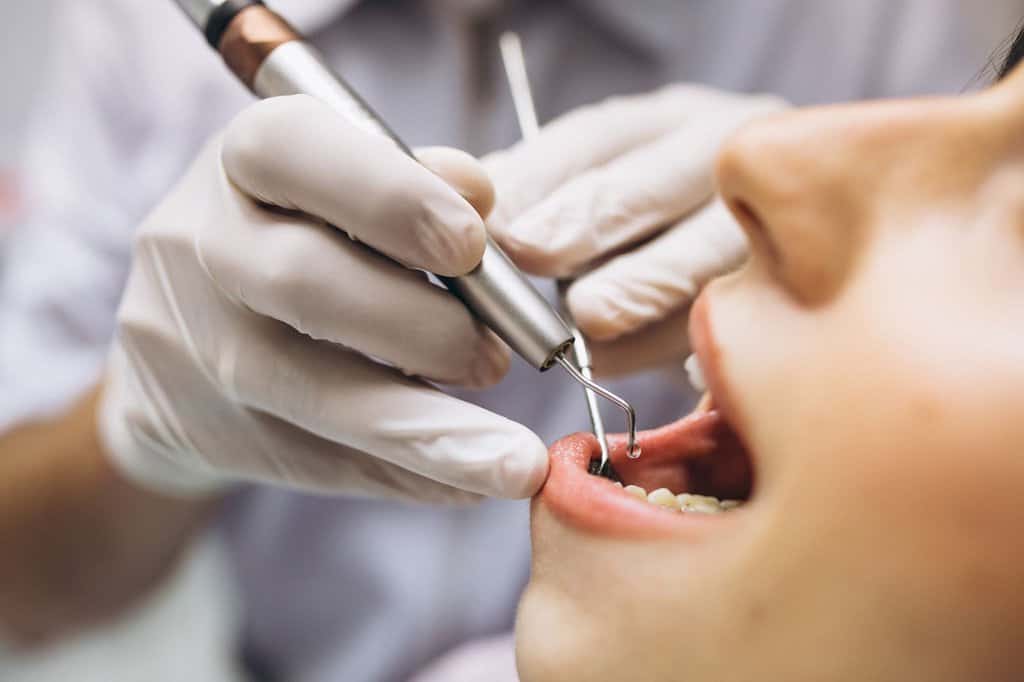 Wisdom tooth impaction