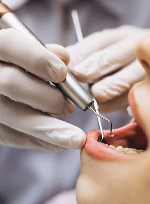 Wisdom Tooth Impaction: Types, Symptoms, and Treatment