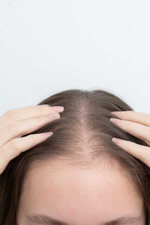 Why Miami Has Become a Hub for Hair Restoration Seekers 